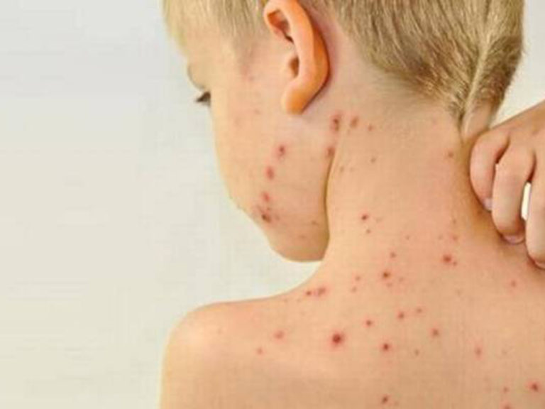 Alerta epidemiológica en Villa del Rosario por posible caso de sarampión