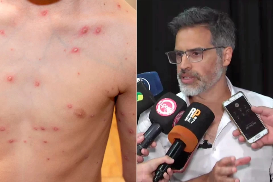 “Varicela en Entre Ríos: el brote que recorre escuelas, barrios y brechas sanitarias”