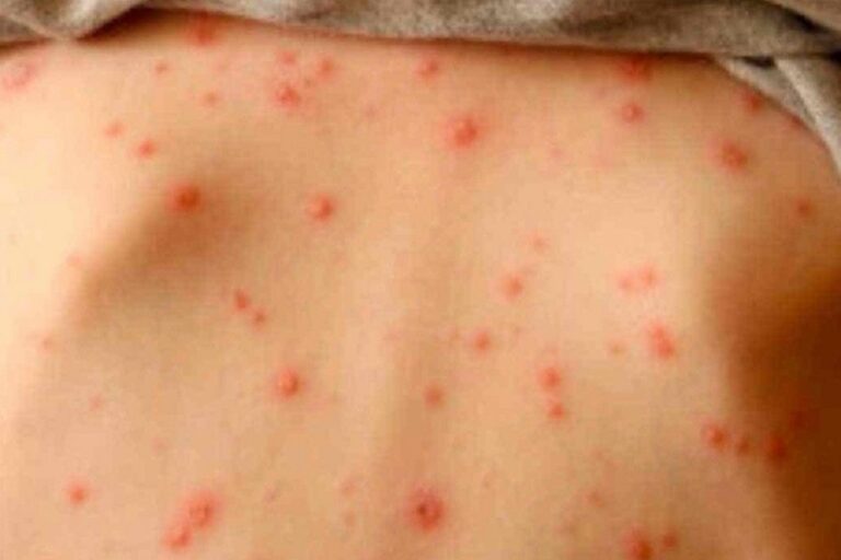 “Alerta sanitaria: el sarampión vuelve a preocupar en la Región de las Américas”