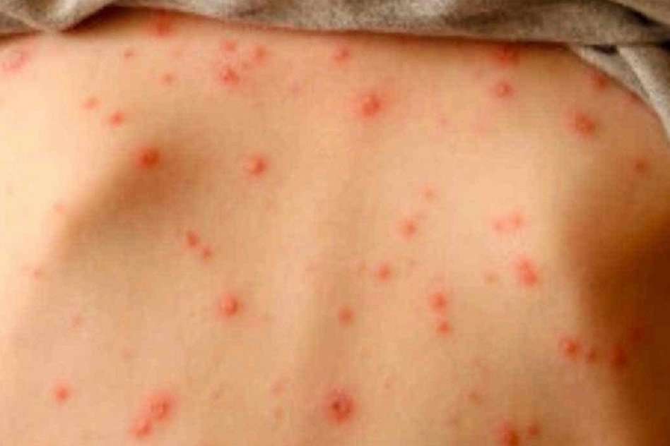 “Alerta sanitaria: el sarampión vuelve a preocupar en la Región de las Américas”